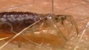 Body lice photo